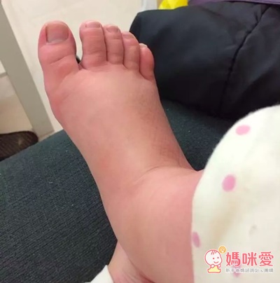 懷孕後期,腳也水腫的好嚴重,走路時都覺得腿部脹脹的